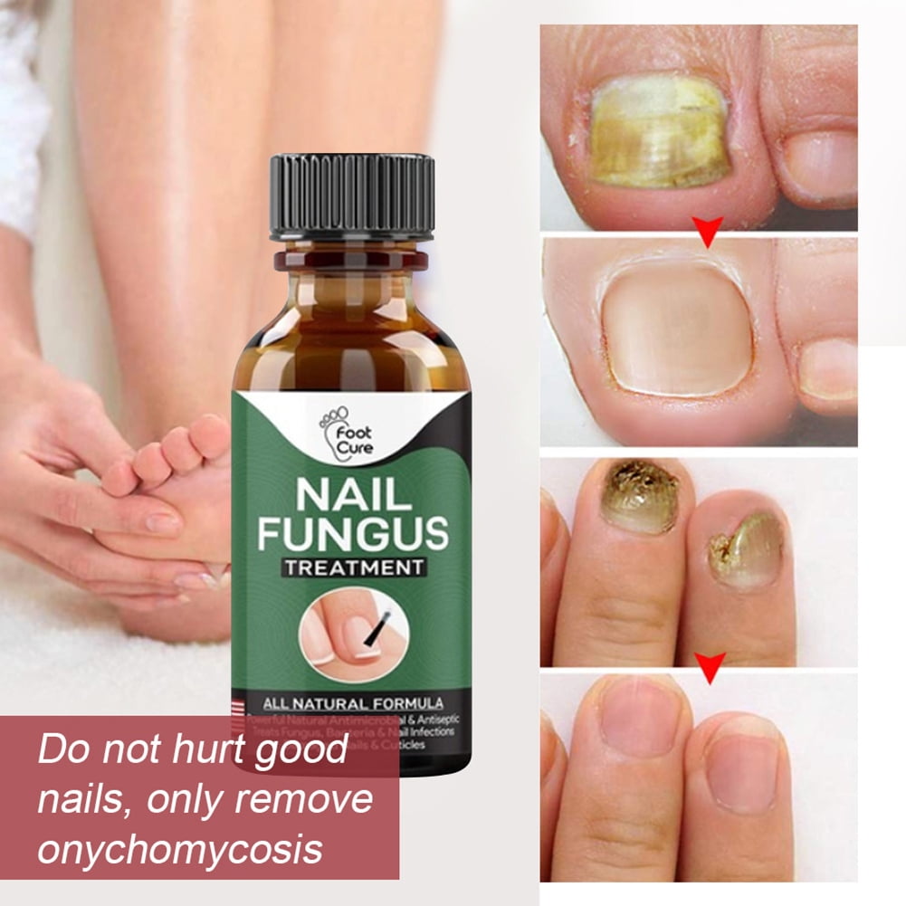 Kerassentials Updates and Reviews 2023 - Best Nail Fungus Treatment